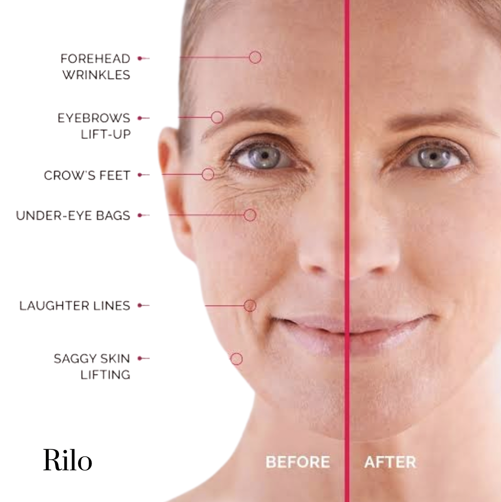 Rilo Eye Tightener Pro